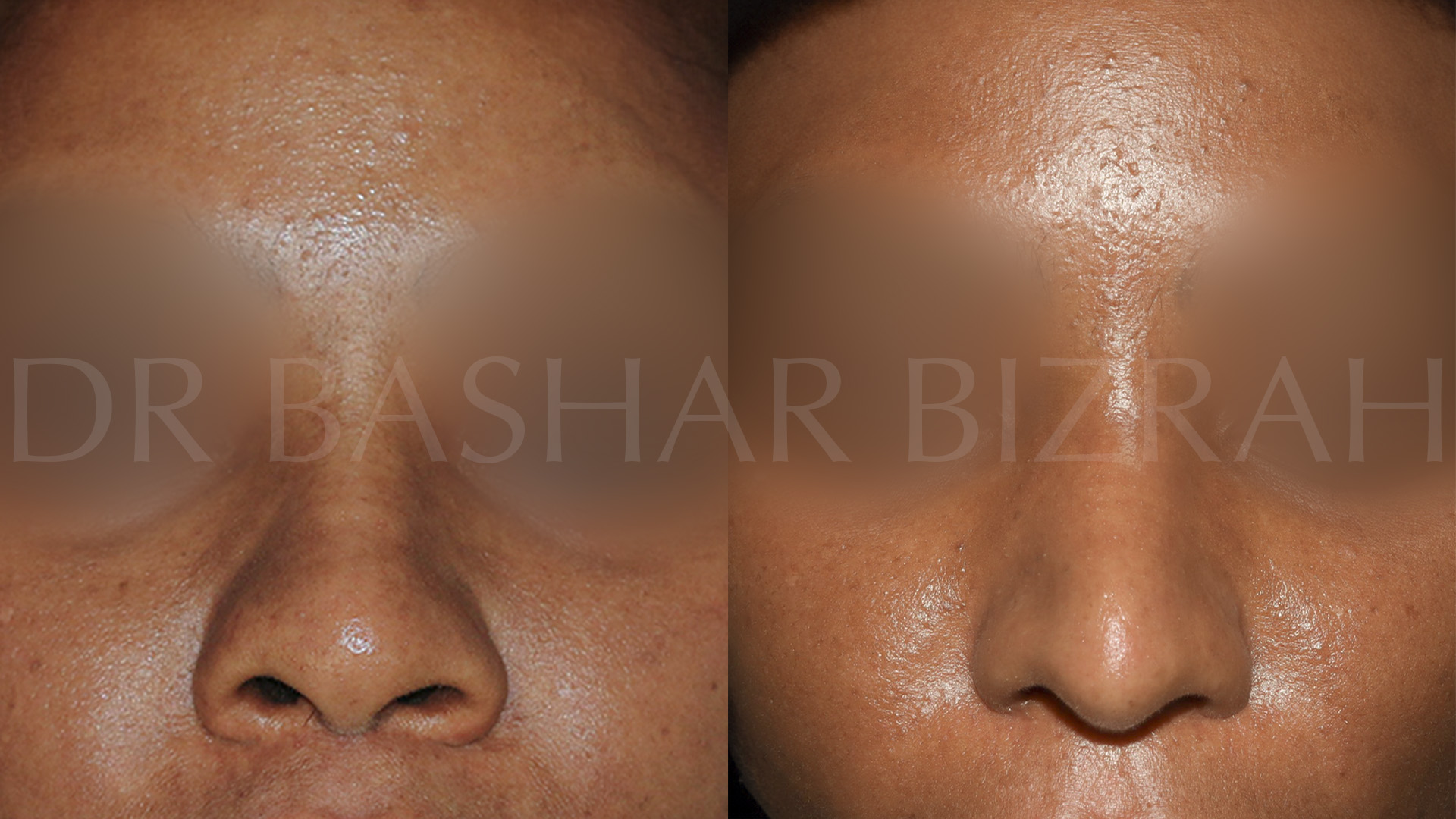 African Rhinoplasty (2)
