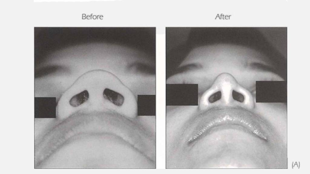 Rhinoplasty Dr Bashar Bizrah Article on: Alar Wedge Excision - Dr ...