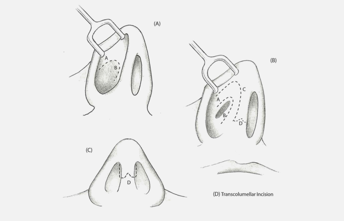 Rhinoplasty Dr Bashar Bizrah Article on: Septorhinoplasty Incisions and ...